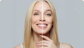 Before and after — gradual, natural-looking volume from biostimulator treatment